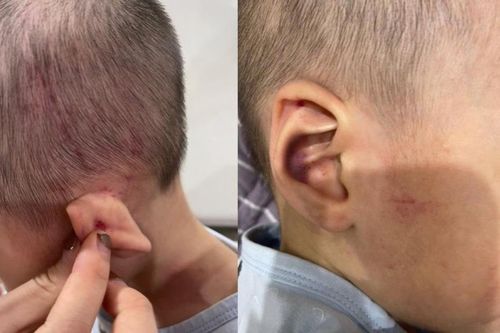 Làm rõ vụ việc bé 2 tuổi tại trung tâm giáo dục chuyên biệt có nhiều vết bầm trên người