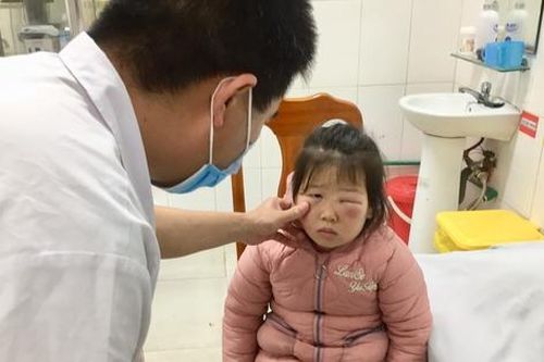 Mắt sưng to hơn do người nhà dùng nước lá trầu không rửa mắt