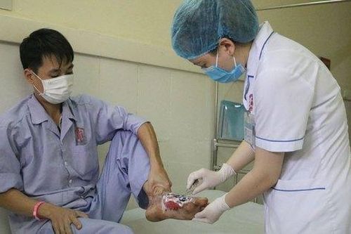 Hoại tử bàn chân do chữa bỏng theo lời thầy lang