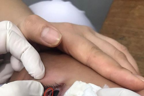 Tắm suối, bé trai 4 tuổi bị vắt chui vào mắt