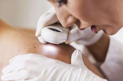 Cô gái phát hiện bị ung thư khi nốt ruồi đổi màu sau một đêm