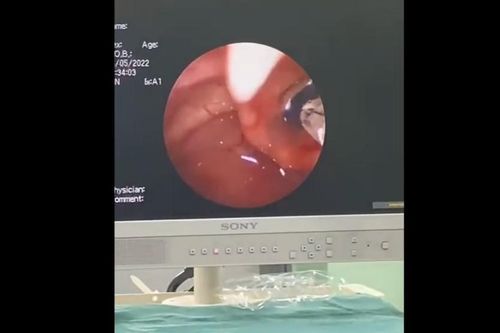 Vắt 8cm căng máu trốn trong đường thở của bệnh nhân