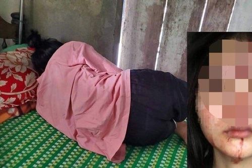 Nữ sinh Huế bị bạn dùng mũ bảo hiểm đánh thương tích 23%