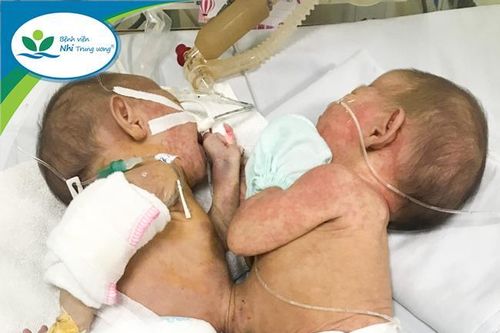 Cặp song sinh dính liền nhau hiếm gặp, khó khăn trong điều trị