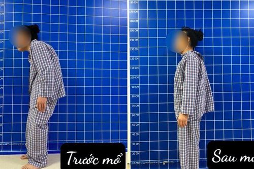 Nhiều giờ phẫu thuật thành công nắn chỉnh gù lưng cho bệnh nhân có HIV