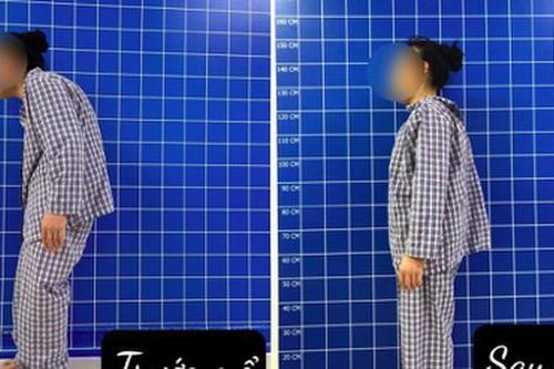 5 tiếng 'cân não' phẫu thuật nắn chỉnh gù cho bệnh nhân nhiễm HIV