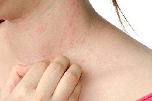 Người bị dị ứng thực phẩm có ít nguy cơ mắc COVID-19