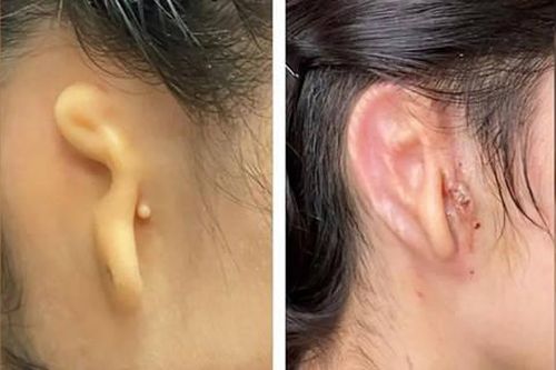 Người phụ nữ được cấy tai in 3D