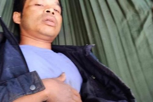 Nam thanh niên bị trâu húc thủng bụng