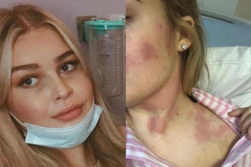 Bị khó nuốt, cô gái đi khám thì sốc khi biết mình mắc ung thư máu hiếm gặp