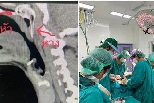 Đang câu cá thì bị cá nhảy luôn vào họng, một người Thái Lan phải phẫu thuật khẩn cấp
