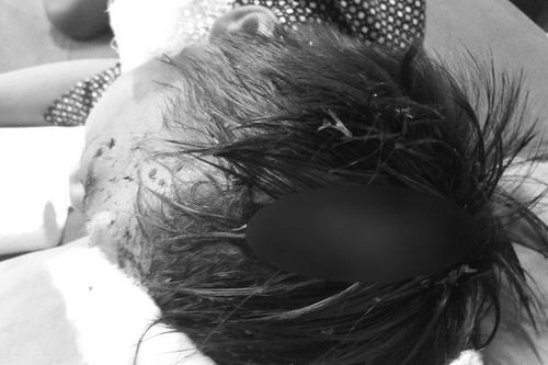 Bé trai 8 tuổi bị chó cắn đa thương tích, lộ xương sọ