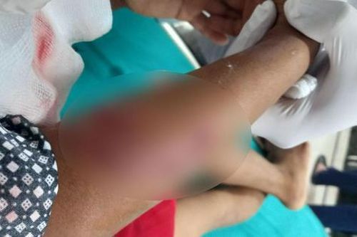 Bé trai 8 tuổi bị chó cắn tổn thương nhiều vùng trên cơ thể