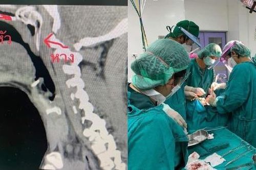 Người đàn ông thoát hiểm sau khi một con cá dài 13 cm chui thẳng vào cổ họng