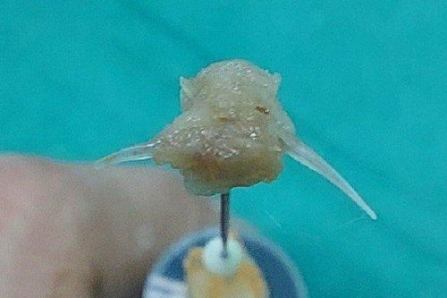 Xương cá găm sâu vào thành thực quản bé 2 tuổi