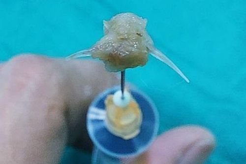 Gắp mảnh xương cá sắc nhọn trong thanh quản của bệnh nhi 2 tuổi