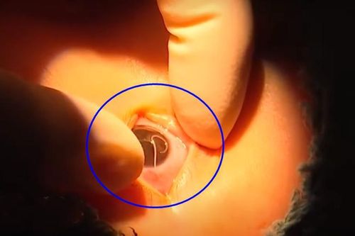Ôm ấp chó cưng, bé trai bị ký sinh trùng làm tổ trong mắt