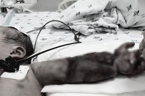 Mắc võng vào máy may, bé mới sinh bị máy ngã đè gãy xương cánh tay