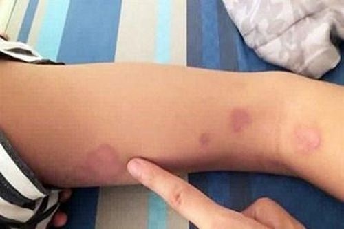 Ghi nhận một trường hợp nhiễm 'vi khuẩn ăn thịt người' tại Đắk Lắk