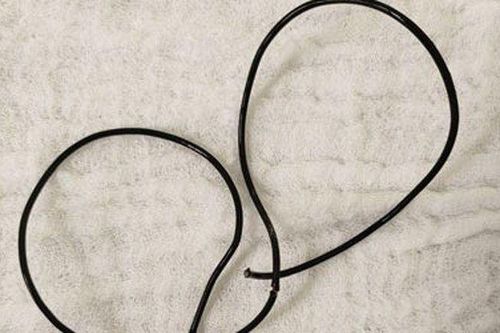 Dây tai nghe 20cm mắc kẹt trong niệu đạo nam thanh niên