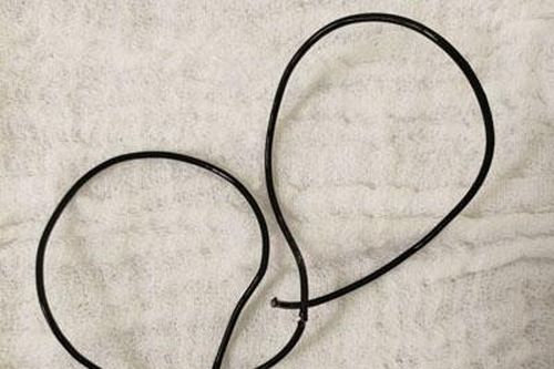 Dây tai nghe dài 20cm mắc kẹt trong niệu đạo của nam thanh niên