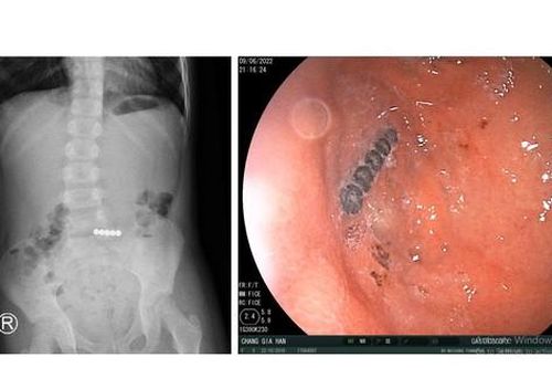 Bác sĩ gắp ra 5 viên bi nam châm từ bụng bé gái 6 tuổi