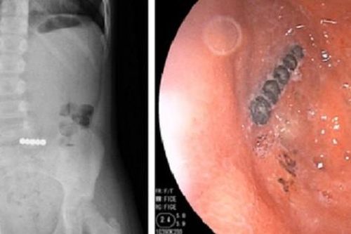 Bé gái 6 tuổi nuốt 5 viên bi nam châm, cảnh báo nguy hiểm từ đồ chơi cho trẻ nhỏ