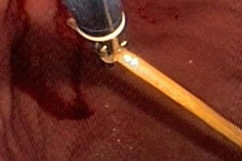 Người đàn ông nhập viện cấp cứu vì thói quen sau bữa ăn nhiều người mắc