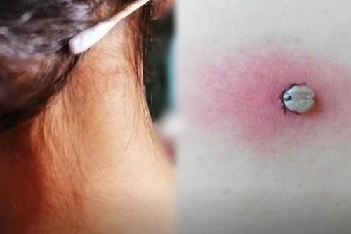 Người mẹ rùng mình khi biết 'nốt ruồi lạ' trên người con là 'quái vật' hút máu