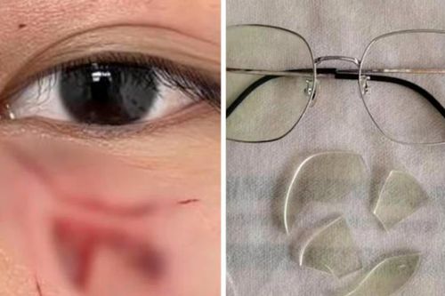 Học sinh Trung Quốc bị giáo viên đấm rách mặt, phải khâu 16 mũi