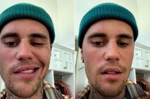 Chứng Ramsay Hunt khiến ca sĩ Justin Bieber bị liệt mặt là gì?