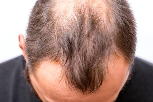 FDA Mỹ lần đầu tiên phê duyệt thuốc trị hói