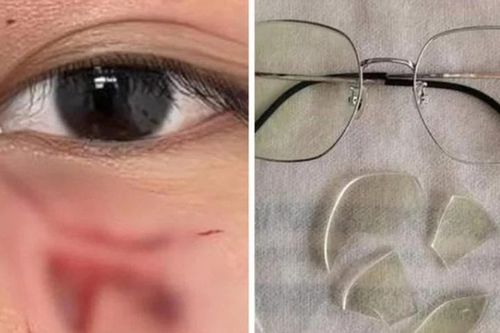 Thầy giáo đấm học sinh rách mắt, phải khâu 16 mũi vì một lý do khiến dân tình 'sôi máu'