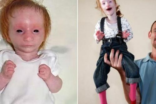 'Bé gái nhỏ nhất thế giới' 7 tuổi vẫn chưa nặng 4kg và nghị lực sống khiến người đời thán phục