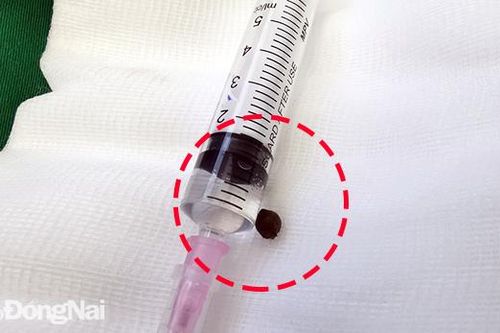 Hy hữu: Gắp hạt tiêu nằm trên đỉnh phổi suốt 7 năm
