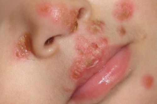 Cảnh giác với bệnh chốc ở trẻ trong mùa hè