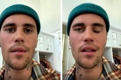 Ám ảnh đeo bám cả đời khi nhiễm virus gây liệt mặt như Justin Bieber