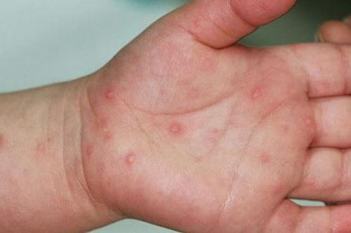 Ghi nhận hơn 6.700 ca tay chân miệng ở TP HCM, chuyên gia khuyến cáo cách phòng biến chứng nguy hiểm