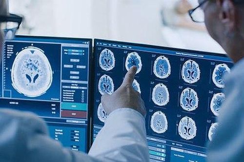 Phát hiện bệnh Alzheimer giai đoạn sớm với độ chính xác gần 100%