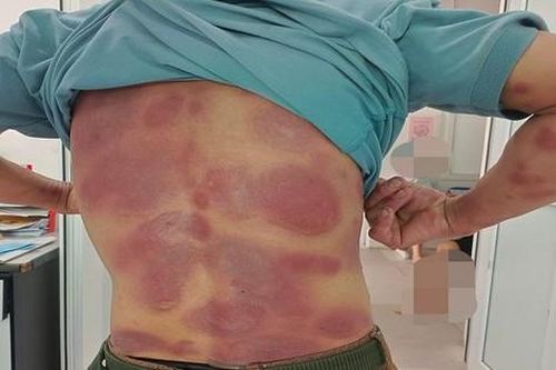 Lở loét toàn thân vì tự mua thuốc điều trị