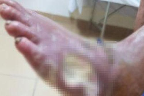 Suýt mất bàn chân vì dùng thuốc nam chữa bệnh