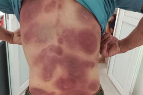 Nhiễm độc toàn thân do tự dùng thuốc điều trị viêm gan B