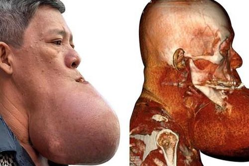 Cứu bệnh nhân bị 'nổ tung' khối u khổng lồ