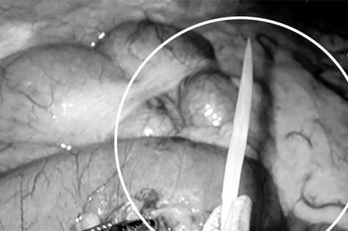 Một bệnh nhân bị xương cá đâm xuyên thủng ruột non