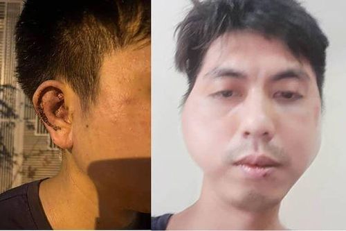 Hà Nội: Giám định thương tích nhân viên bị chủ quán lẩu đánh biến dạng khuôn mặt
