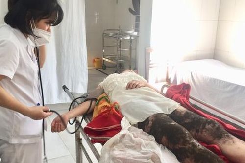 Đắp thuốc nam trị bỏng, thiếu nữ suýt mất đôi chân