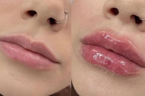 Trào lưu dùng bút làm môi căng mọng