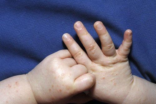Cảnh báo nhiều trẻ em mắc đậu mùa khỉ