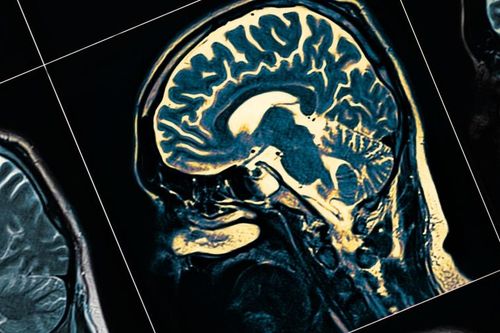 Australia tạo đột phá trong nghiên cứu về bệnh Alzheimer