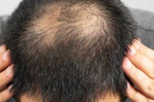 Đàn ông hói đầu có phải liên quan đến vấn đề sinh lý?